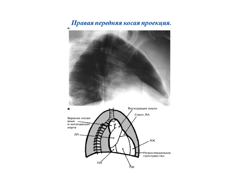 Правая передняя косая проекция.